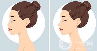 鼻子整形前后圖變化太*，不僅想做