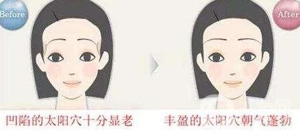 濟南自體脂肪填充太陽穴價格貴不貴?