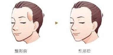 濟南自體脂肪填充太陽穴價格貴不貴?