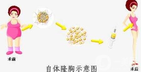 自體脂肪填充豐胸的風(fēng)險(xiǎn)有哪些?弊端有哪些?