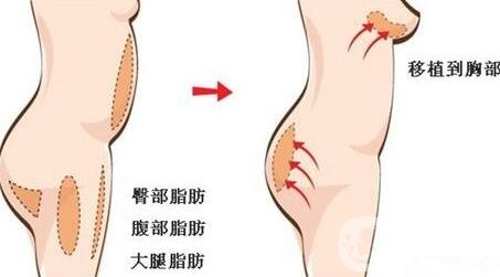 自體脂肪填充豐胸的風(fēng)險(xiǎn)有哪些?弊端有哪些?