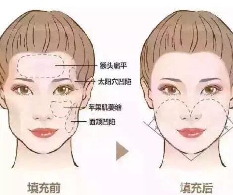 自體脂肪填充價格大概要多少錢?