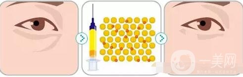 自體脂肪填充淚溝恢復過程圖片展示