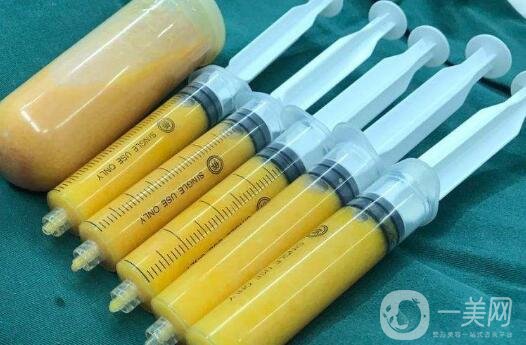 自體脂肪填充隆鼻部會不會變寬?