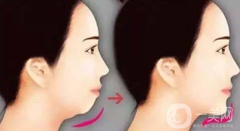 自體脂肪填充下巴