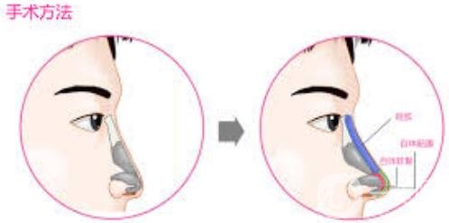 假體隆鼻術(shù)