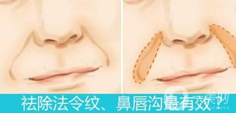 自體脂肪填充鼻唇溝