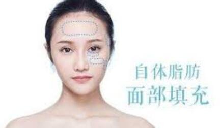 自體脂肪填充多久補打