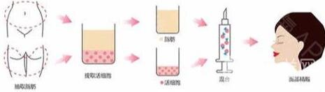 自體脂肪填充減少抬頭紋