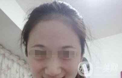 自體脂肪填充抬頭紋