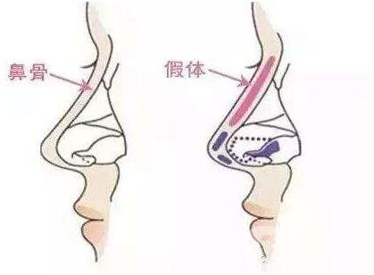 假體隆鼻會(huì)變形嗎?鼻子會(huì)凹陷下去嗎?