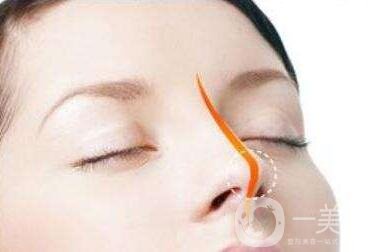 現(xiàn)在這個(gè)行情墊個(gè)鼻子多少錢?貴不貴?