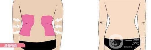 腰腹部吸脂后多久消腫?要多久才不腫?