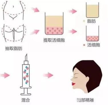 自體脂肪填充能保持多少年?能終身保持嗎?