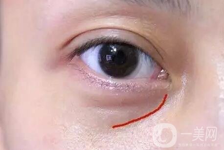 淚溝自體脂肪填充術(shù)后有些腫正常嗎?會恢復(fù)嗎?