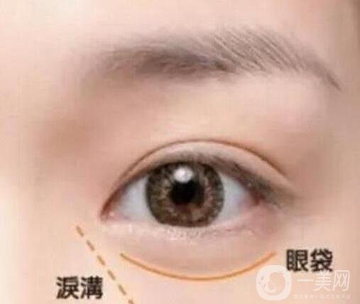 淚溝自體脂肪填充術(shù)后有些腫正常嗎?會恢復(fù)嗎?