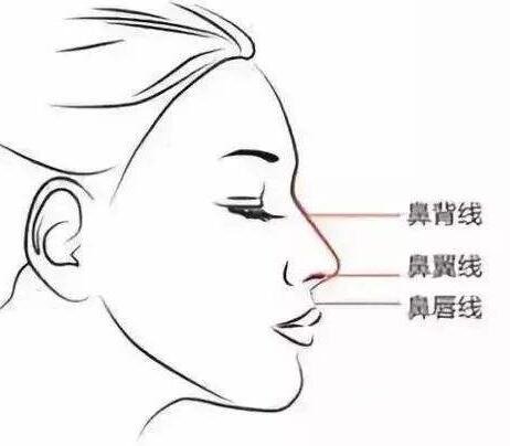 肋骨隆鼻多久可以修復?修復用什么材料?