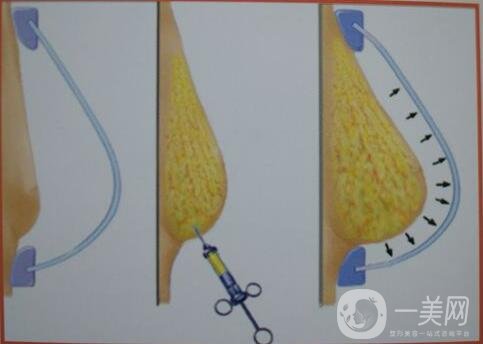 上海自體脂肪填充隆胸價格大概要多少錢?