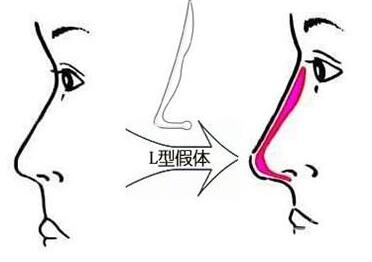 假體隆鼻整形手術(shù)