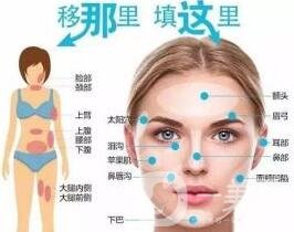 自體脂肪填充的利弊分別有哪些?