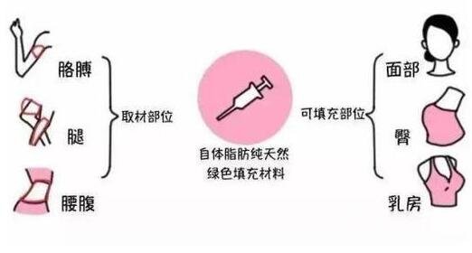 自體脂肪填充介紹?全國哪些機(jī)構(gòu)做得好?