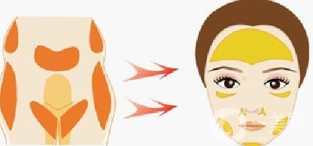 自體脂肪填充術(shù)前檢查及術(shù)后護理事項