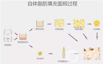 北京自體脂肪填充醫(yī)院有哪些？好的有哪些？