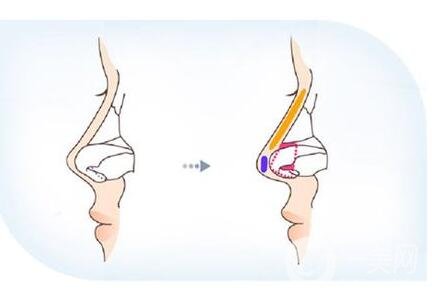 鼻小柱太長怎么縮短?方法介紹