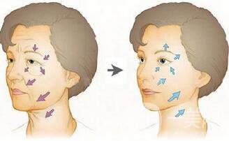 午間除皺到底是真是假?當(dāng)真有那么快?