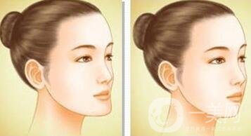 下巴突出怎么整？矯正手術(shù)原來(lái)是這么做的