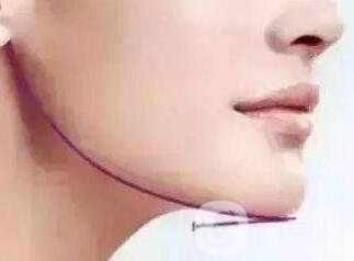 下巴突出怎么整？矯正手術(shù)原來(lái)是這么做的