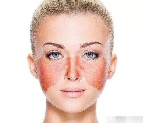 如何去蝴蝶斑不反彈?正確的方法在這里!