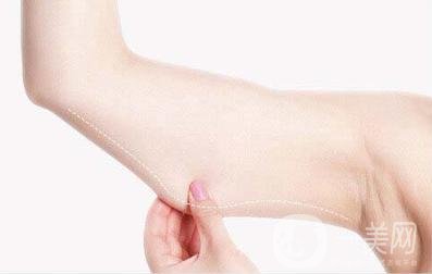 上臂吸脂減肥術(shù)靠譜嗎?能細(xì)多少?