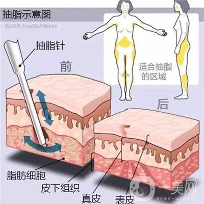 腰腹環(huán)吸后要腫多長時間呢？可以活動嗎？
