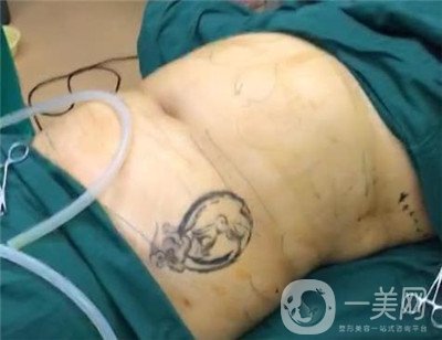 腰腹環(huán)吸后要腫多長時間呢？可以活動嗎？