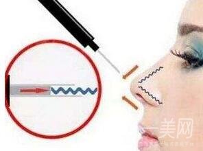 自體軟骨隆鼻整形疼嗎？*嗎？