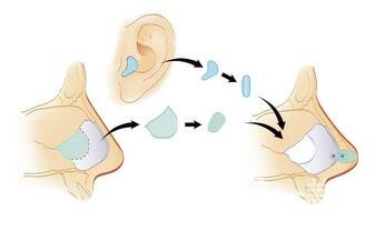 自體軟骨隆鼻整形疼嗎？*嗎？