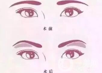 玻尿酸眉弓填充怎么打？會(huì)下滑嗎？