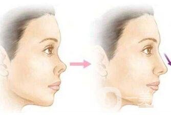 朝天鼻怎么整形？手術(shù)神秘面紗揭幕