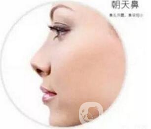 朝天鼻怎么整形？手術(shù)神秘面紗揭幕
