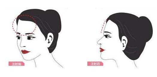 自體脂肪填充額頭后遺癥有哪些?