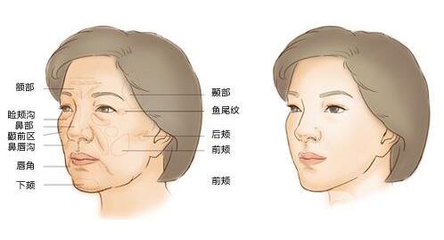 自體脂肪填充要注意什么?術(shù)后怎么護理?