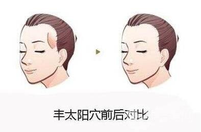 自體脂肪填充太陽穴危險(xiǎn)嗎?有哪些風(fēng)險(xiǎn)可以提前規(guī)避?