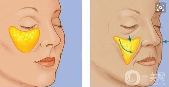 自體脂肪填充傷到神經(jīng)怎么辦?怎么避免啊?