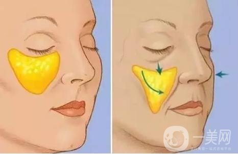 自體脂肪填充蘋果肌需幾次手術(shù)才能*果?