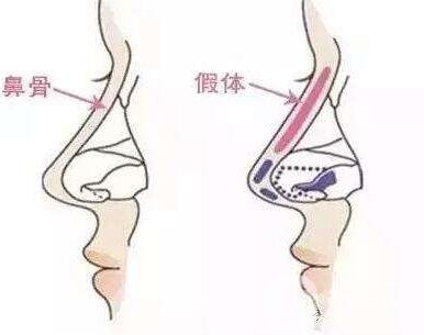 假體隆鼻需要多少錢?進(jìn)口的要多少錢?