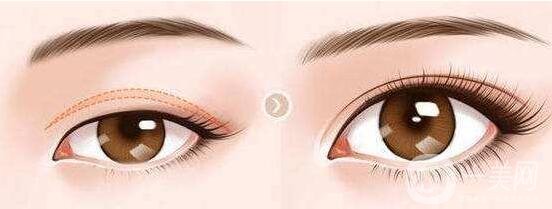 上瞼下垂手術(shù)要多少錢?貴嗎?