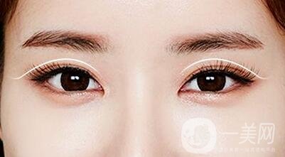 割雙眼皮過(guò)程大概需要多長(zhǎng)時(shí)間?