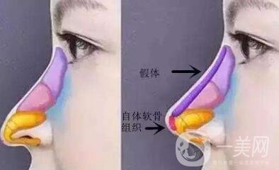 北京整容墊鼻梁多少錢？附隆鼻價格明細(xì)一覽表