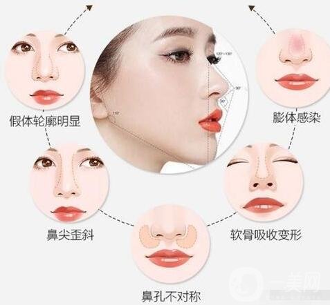 隆鼻修復(fù)手術(shù)價格多少錢?什么原因會影響價格?